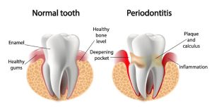 Mouth infections 