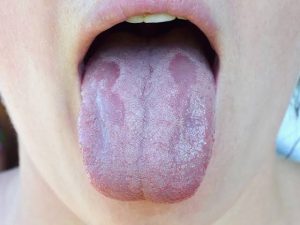 Mouth infections