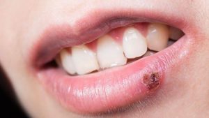 Mouth infections 