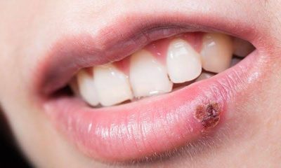 Mouth infections