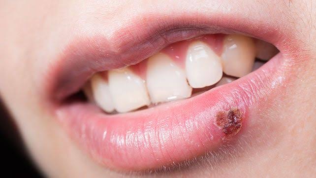 Mouth infections