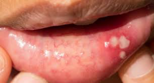 Mouth infections 