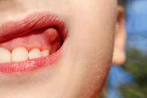 Mouth infections 