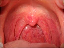 Causes of sore throat