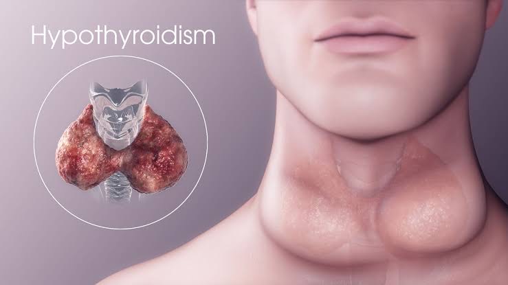 Thyroid issues 