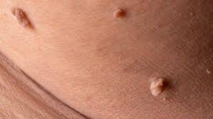 Abnormal skin growths 