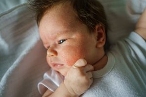 CAUSES OF SKIN RASHES ON BABIES