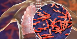 HOW TUBERCULOSIS CAN BE TREATED