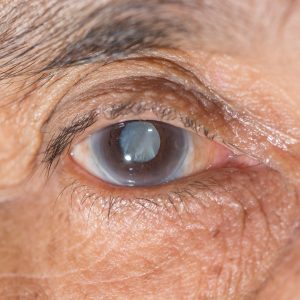 CATARACTS: TREATMENT OPTIONS