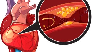 PREVENTION OF CORONARY DISEASES