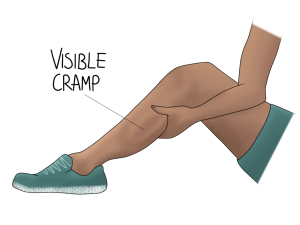 treatment for muscle cramps