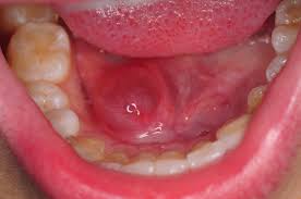 TREATMENT OF GROWTH UNDER THE TONGUE