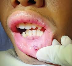 PREVENTION OF ORAL MUCOCELE