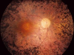 SOLUTIONS FOR RETINA DISORDERS