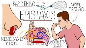 PREVENTION OF EPISTAXIS