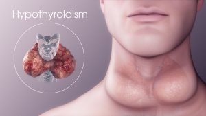 Prevention of Hypothyroidism