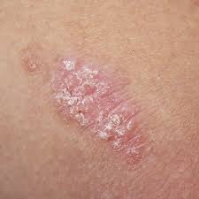 Psoriasis