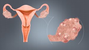 TREATMENT OF POLYCYSTIC OVARY SYNDROME