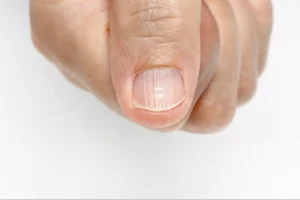 PREVENTION OF RIDGES IN NAILS