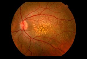 CAUSES OF MACULAR DEGENERATION 