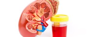 PREVENTION OF HEMATURIA