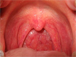 PREVENTION OF PHARYNGITIS
