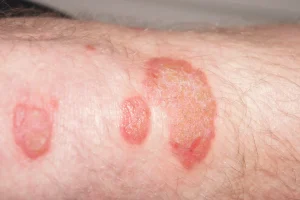 PREVENTION OF PSORIASIS