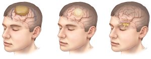 BRAIN TUMOR