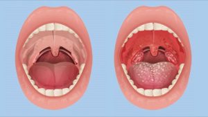 CAUSES OF PHARYNGITIS