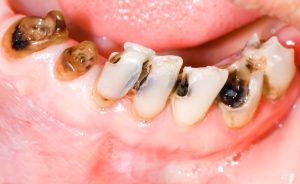 TREATMENT OF TOOTH DECAY