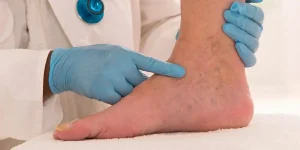 TREATMENT OF CHRONIC VENOUS INSUFFICIENCY