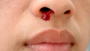 CAUSES OF NOSEBLEEDS
