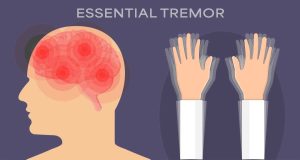 HOW TO TREAT ESSENTIAL TREMOR