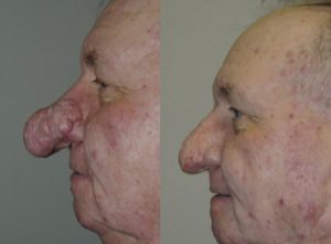 RHINOPHYMA