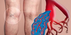 CAUSES OF DEEP VEINS THROMBOSIS