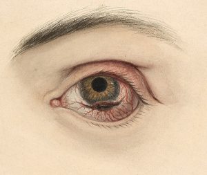 SIGNS OF EYE CANCER