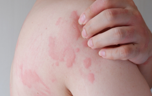 TYPES OF ALLERGIES