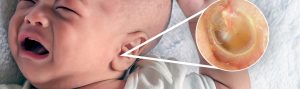 CHILDREN OTITIS MEDIA