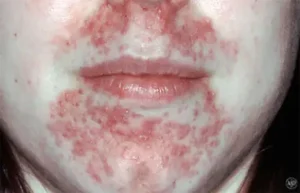 PERIORAL DERMATITIS