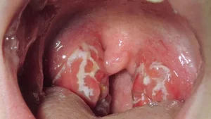 STREP THROAT