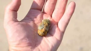 TREATMENT OF GALLSTONES