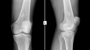 CAUSES OF EWING SARCOMA