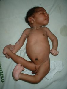 TREATMENT OF EDWARDS SYNDROME