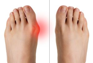 BUNIONS