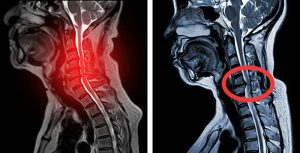 CERVICAL MYELOPATHY