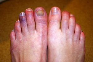 CHILBLAINS