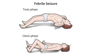 FEBRILE SEIZURES