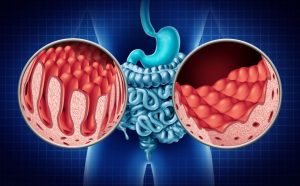 CELIAC DISEASES