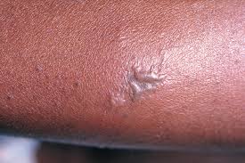 SYMPTOMS OF GONORRHEA