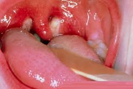 GLANDULAR FEVER